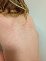 Is this eczema or chicken pox (pics)