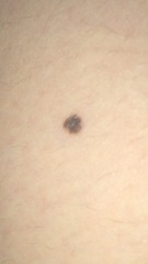 Anyone know about moles?