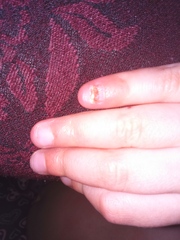 Exposed nail bed - how to look after it?