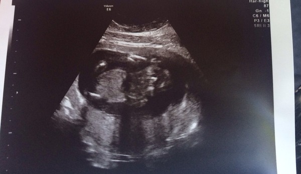 Another boy/girl guess pic!