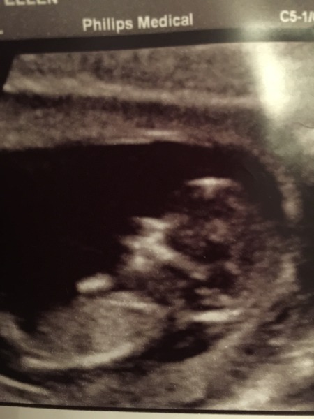 Nasal bone visible? Opinions appreciated