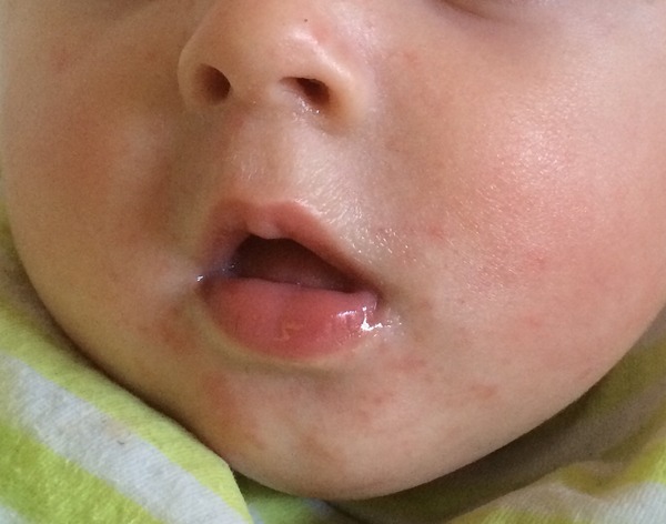 Chin/face rash spreading