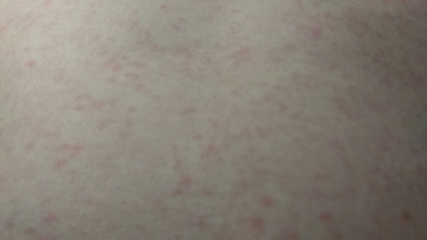 Heat rash or something else (with photo)