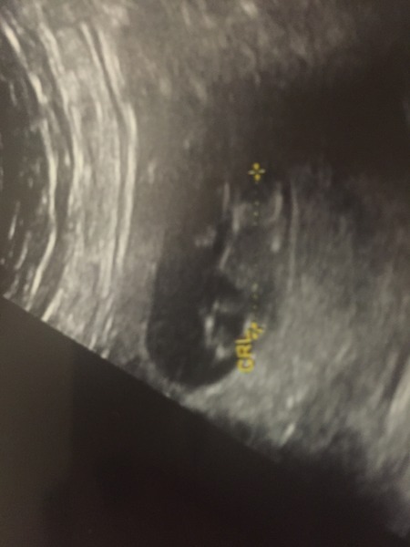 Talipes/clubfoot at 10 weeks- am I being ridiculous?