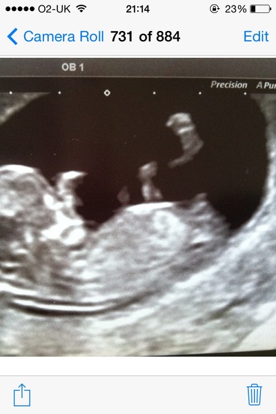 12 week nub guess anyone?!