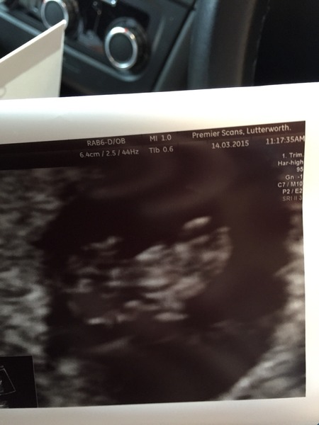What to expect from a 7 week scan?