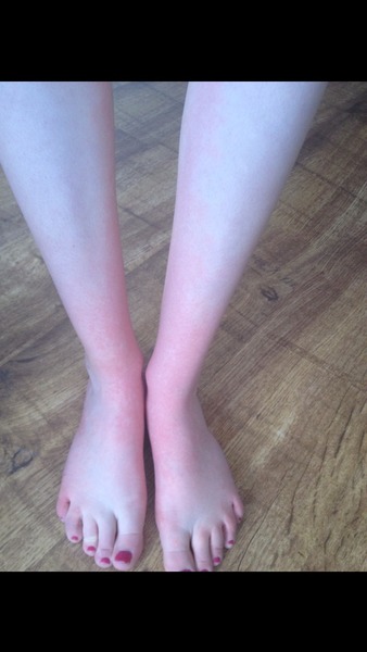 What's wrong with my toes? Any ideas would be greatly appreciated. Photos included.