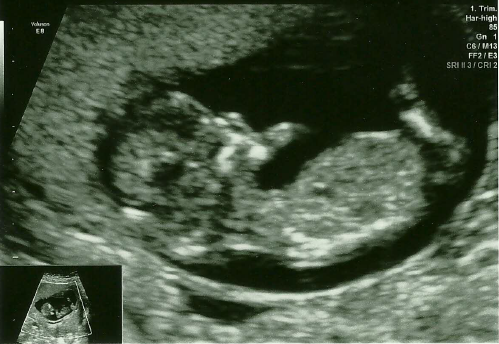 Puking our way through the first trimester: It's the November 2015 ladies here! Hand out plenty of ginger tea, cold drinks and some lovely scan pics soon!