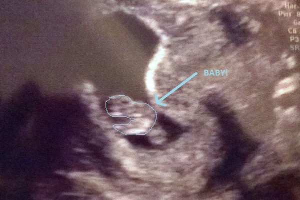 What to expect from a 7 week scan?