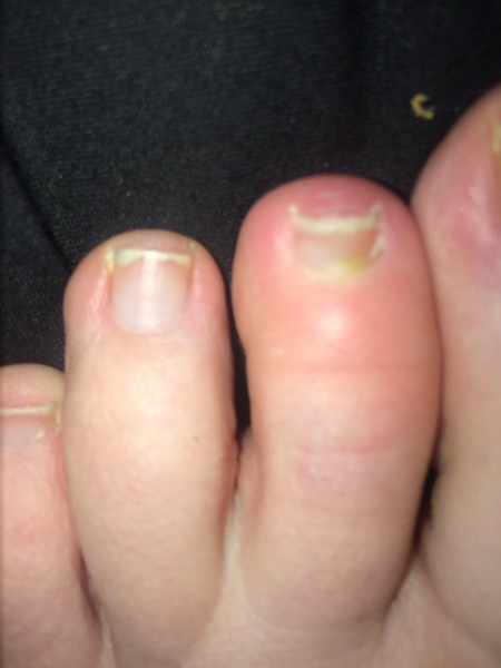 Chiropodist advice requied