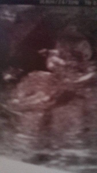 nub theory confused with 2 ultrasound pics!