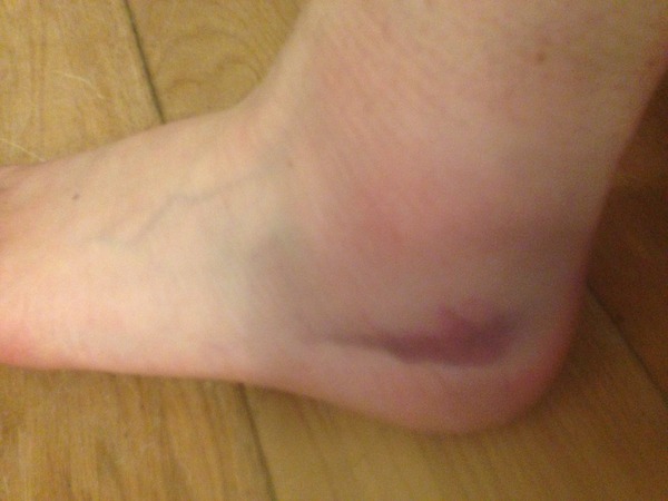 Sprain or fracture?
