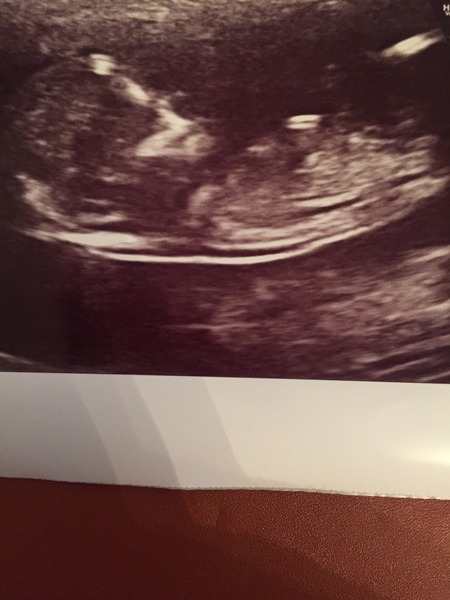 12 week scan. Any guesses?