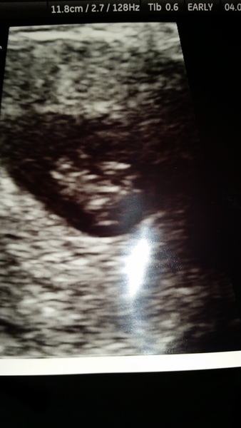 The best shit place to be grads - Early pregnancy after miscarriage - hopes and fears