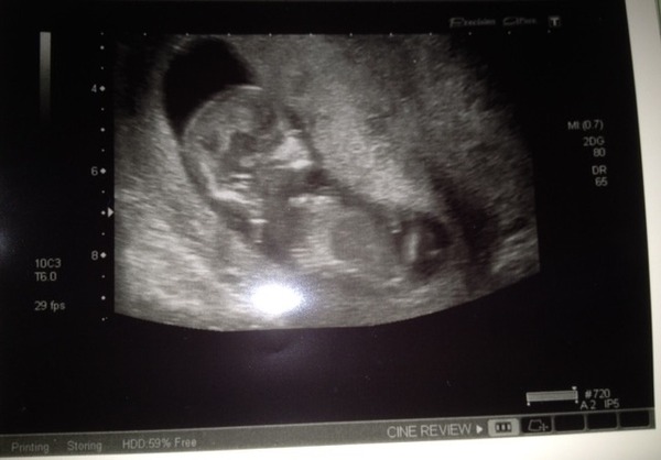 Boy or girl? 12 week scan pic. (Reported)