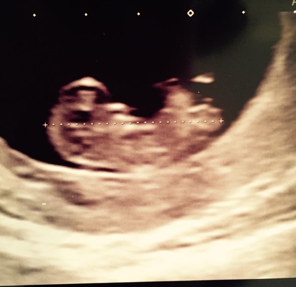 Puking our way through the first trimester: It's the November 2015 ladies here! Hand out plenty of ginger tea, cold drinks and some lovely scan pics soon!