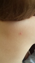 Could yhis be chicken pox?