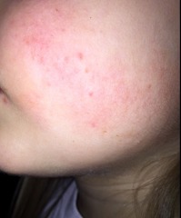 Child Acne