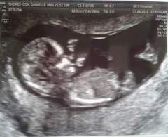 Best shit place grads # 2- still pregnant after miscarriage