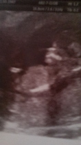 nub theory confused with 2 ultrasound pics!
