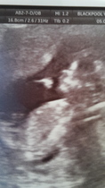 nub theory confused with 2 ultrasound pics!