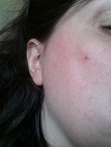 Laser treatment for spider veins on face??