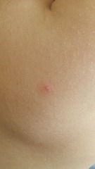 Could yhis be chicken pox?