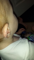 11 month old - rash on ear?