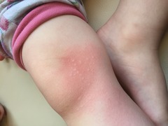 What could this rash be