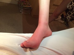 What's wrong with my toes? Any ideas would be greatly appreciated. Photos included.