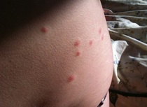 What's going on? The whole family has hives!