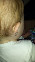 11 month old - rash on ear?