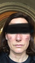 Laser treatment for spider veins on face??