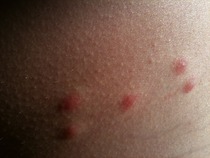 What's going on? The whole family has hives!