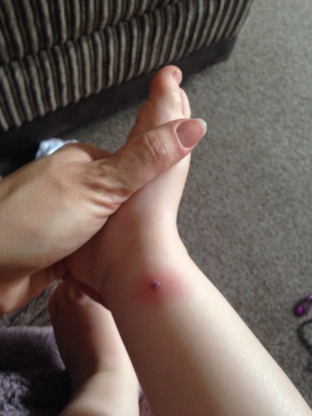 18mo old pox, infected?