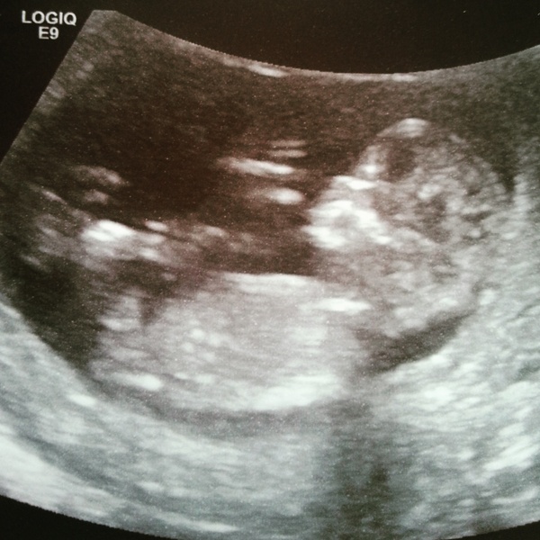 November 2015 mums to be! Here we are! Our bus is decorated with scan pics, our appetites are beginning to heal, and spring is in the air!