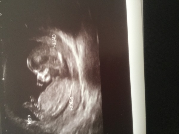 December 2015 #3 - riding out the first trimester!!