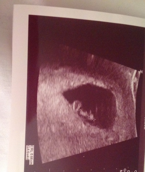 what to expect at 6 week early scan (because of past ectopic)
