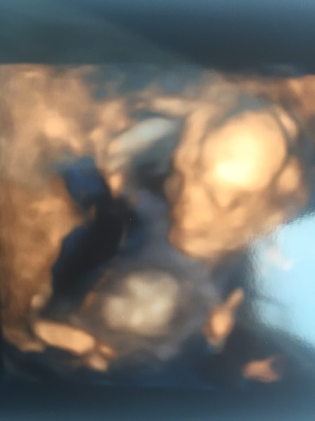16 week sex scans - how accurate?