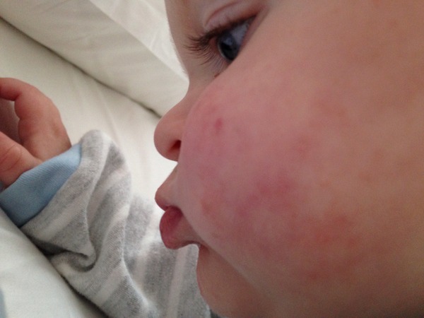 Help! Rash - what is this