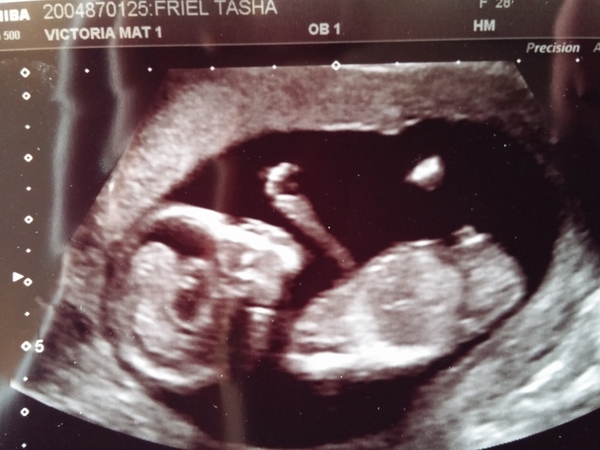 low lying placenta