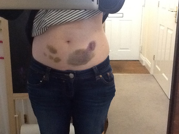 Recurrent miscarriage support, tests, treatments and trying again.