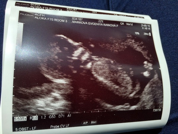 HELP??!! 17 Week Early Gender Scan