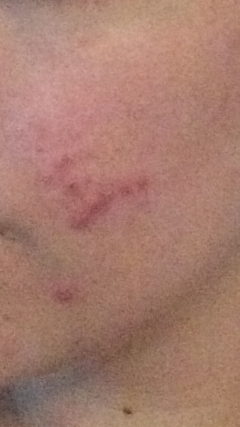 Bad skin since stopping pill