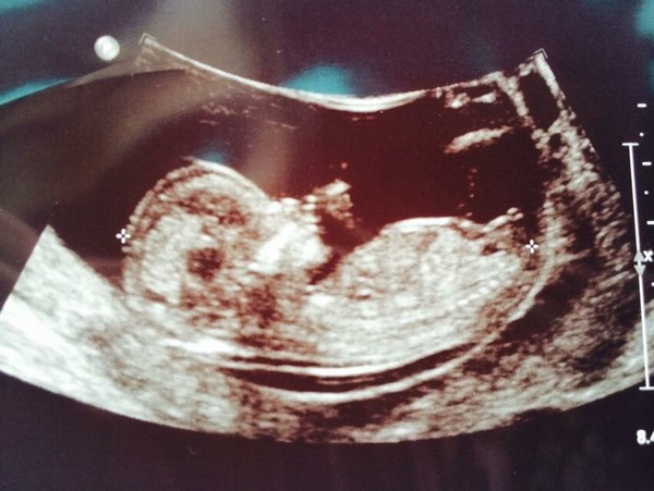 Sorry I can't resist! My 12 week scan appears to show the babys sex .. but which is it?! lol ... take a look ...