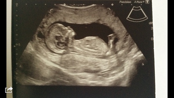 12wk scan boy or girl? &#55357&#56842