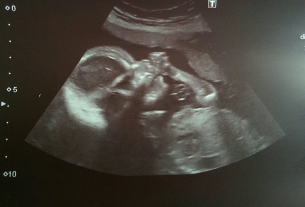 September crew - baby bumps are appearing and we're emerging as team blue, pink or yellow! Thread 8 :)