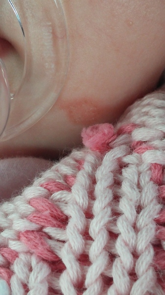 Not to use this steroid cream on my 7 month old?