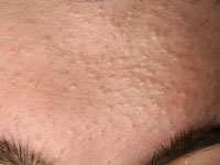 Tiny bumps on my DD's forehead