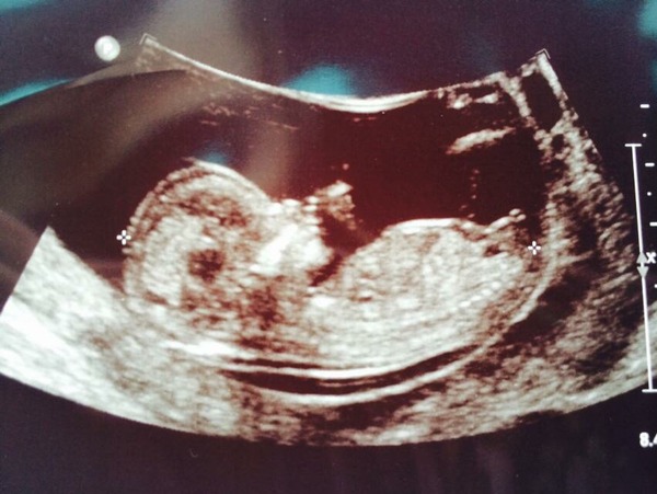 12 week scan - boy or girl?